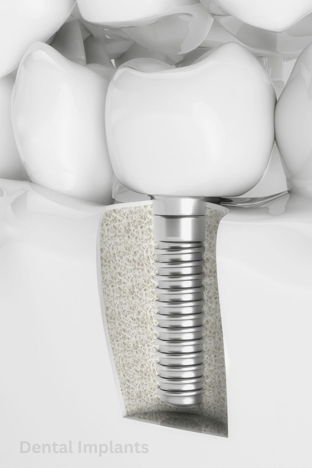 Dental Implants - IB Clinic Images