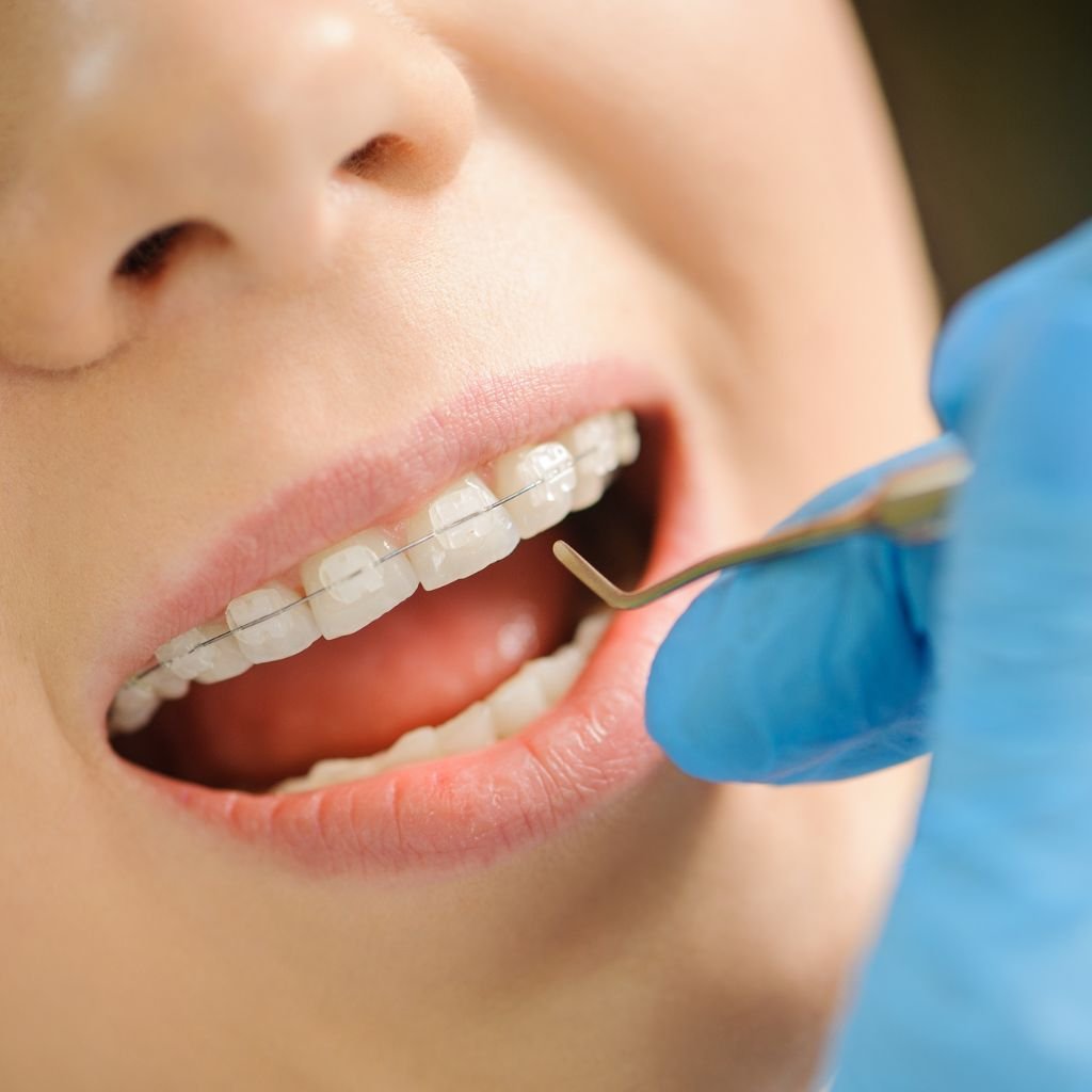 Ceramic braces image
