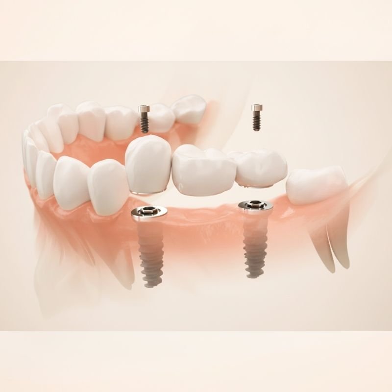Dental implant treatment at Invisible Braces Dental and Skin Polyclinic Dubai