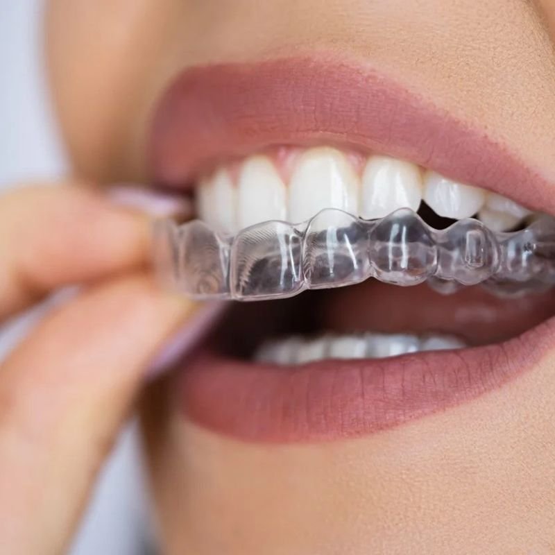 Invisalign clear aligner at Invisible Braces Dental and Skin Polyclinic Dubai