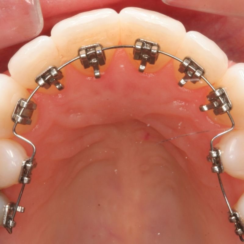 Lingual braces treatment at Invisible Braces Dental and Skin Polyclinic Dubai