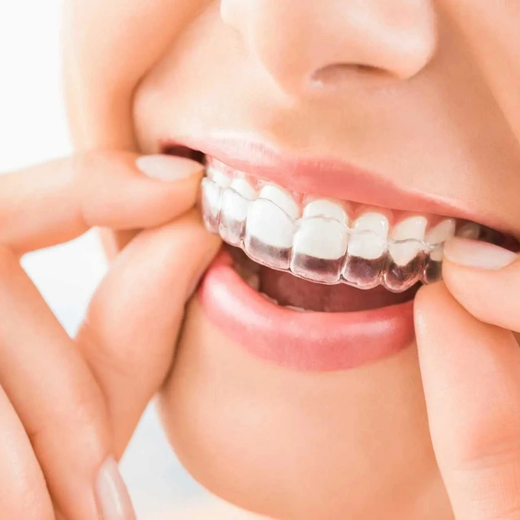 Close-up image of a person placing an Invisalign clear aligner onto their upper teeth, demonstrating the comfort and transparency of aligners used at Invisible Braces Dental & Skin Clinic Dubai under the care of Dr. Nikhil Sharma.