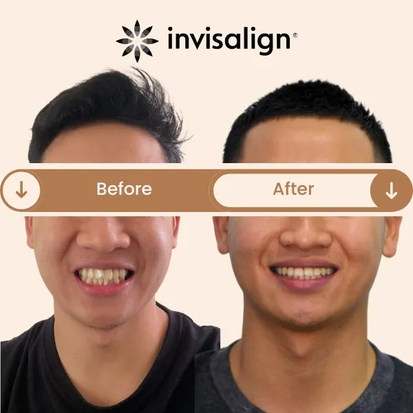 Before and after Invisalign treatment showing correction of crossbite and teeth misalignment, resulting in a straighter smile and improved bite — treated by Dr. Nikhil Sharma at Invisible Braces Dental & Skin Clinic Dubai.
