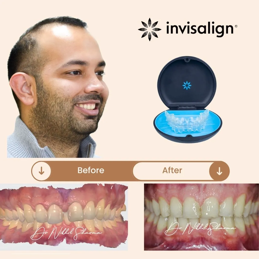 Before and after Invisalign treatment showing correction of a severe deep bite and closure of spacing between upper front teeth (diastema) by Dr. Nikhil Sharma at Invisible Braces Dental & Skin Clinic Dubai — resulting in a balanced, confident smile.