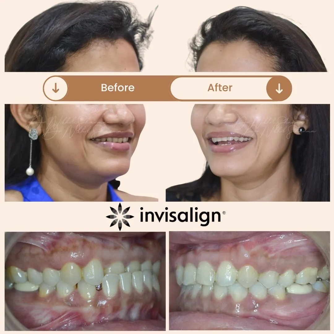 [12:12 PM, 11/8/2025] +971523928693: 🏷 Image Title (for website / SEO)</p>
<p>Class II Division 2 Orthodontic Treatment – Retroclined Upper Teeth and Retruded Lower Jaw Correction by Dr. Nikhil Sharma | Invisible Braces Dental & Skin Clinic Dubai</p>
<p>📝 Alt Text (for image upload)</p>
<p>Before and after orthodontic treatment showing correction of severely retroclined upper front teeth and forward repositioning of a retruded lower jaw by Dr. Nikhil Sharma at Invisible Braces Dental & Skin Clinic Dubai. The result shows a balanced facial profile and improved smile line.</p>
<p>📄 Short Description (for page caption or meta description)</p>
<p>Orthodontic correction of a Class II Division 2 case with severely retroclined upper incisors and a retruded lower jaw. The treatment brought the jaw forward and created a harmonious, confident facial profile — performed by Dr. Nikhil Sharma, Invisible Braces Dental & Skin Clinic Dubai.<br />
[12:15 PM, 11/8/2025] +971523928693: kindly update this image from the drive - made some changes<br />
[12:17 PM, 11/8/2025] +971523928693: 🏷 Image Title</p>
<p>Invisalign Clear Aligners – Severe Deep Bite Correction and Diastema Closure by Dr. Nikhil Sharma | Invisible Braces Dental & Skin Clinic Dubai</p>
<p>📝 Alt Text</p>
<p>Before and after Invisalign treatment showing correction of a severe deep bite and closure of spacing between upper front teeth (diastema) by Dr. Nikhil Sharma at Invisible Braces Dental & Skin Clinic Dubai — resulting in a balanced, confident smile.</p>
<p>📄 Short Description</p>
<p>This patient had a severe deep bite with gaps between the upper front teeth. Using Invisalign clear aligners, Dr. Nikhil Sharma achieved bite correction, gap closure, and smile enhancement — all without traditional braces, providing a discreet and comfortable orthodontic solution in Dubai.<br />
[12:18 PM, 11/8/2025] +971523928693: Invisalign Clear Aligners – Anterior Crossbite Correction for Doctor by Dr. Nikhil Sharma | Invisible Braces Dental & Skin Clinic Dubai<br />
