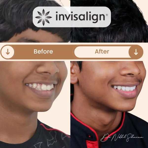 Before and after Invisalign treatment showing correction of protruding upper teeth and improved smile alignment in a teenage patient — treated by Dr. Nikhil Sharma at Invisible Braces Dental & Skin Clinic Dubai.