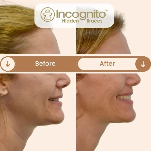 Before and after treatment showing an adult patient’s improved facial profile achieved through lingual (hidden) braces by Dr. Nikhil Sharma at Invisible Braces Dental & Skin Clinic Dubai — resulting in a straighter smile and enhanced jawline without visible braces.