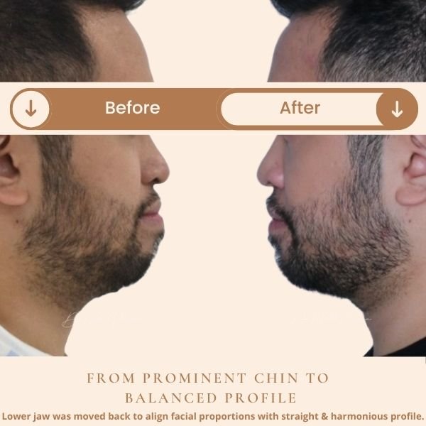 Before and after lower jaw repositioning showing improved facial balance and straight profile – Dr. Nikhil Sharma, Orthodontist Dubai