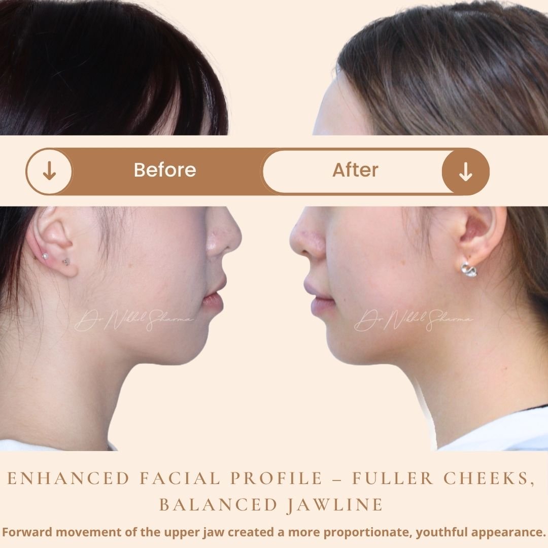 Before and after upper jaw advancement showing fuller cheeks, improved facial profile, and balanced jawline – Dr. Nikhil Sharma, Orthodontist Dubai