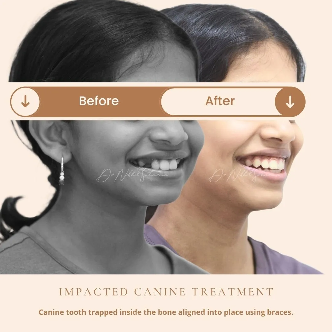 Before and after impacted canine orthodontic treatment showing improved smile alignment – Dr. Nikhil Sharma, Invisible Braces Dental & Skin Clinic Dubai