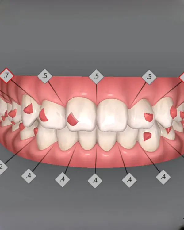 Tooth-colored wires + brackets for aesthetic finish