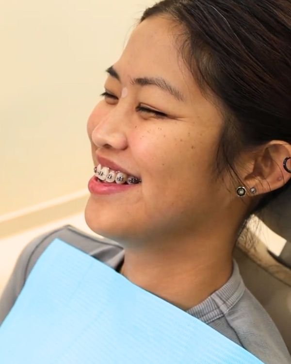 Patient smiling confidently during orthodontic treatment with metal braces under Dr. Nikhil Sharma’s supervision at IB Clinic Dubai.