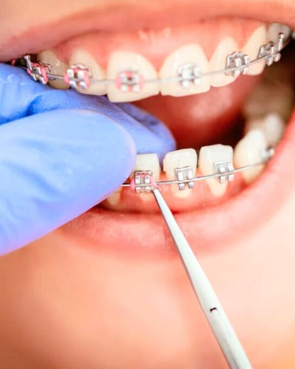 Orthodontist Dr. Nikhil Sharma adjusting metal braces for precise tooth alignment at IB Clinic Dubai.