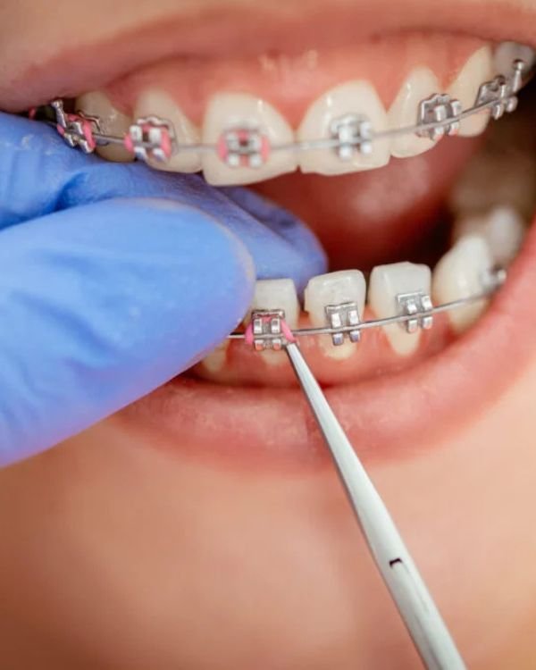 Dr. Nikhil Sharma performing a routine metal braces adjustment to ensure accurate tooth movement and controlled alignment.