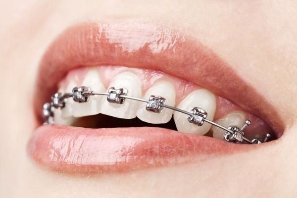 Damon Self-Ligating Braces by Dr Nikhil Sharma – Specialist Orthodontist in Dubai