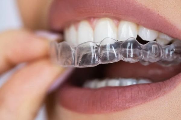 Invisalign Clear Aligners by Dr Nikhil Sharma – Specialist Orthodontist in Dubai.