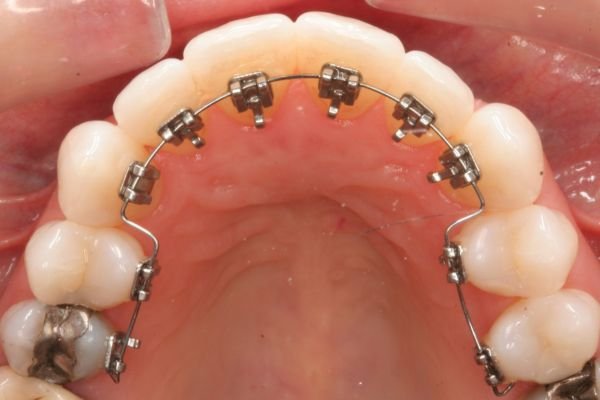 Lingual Braces – Invisible Orthodontic Treatment by Dr Nikhil Sharma, Specialist Orthodontist in Dubai.