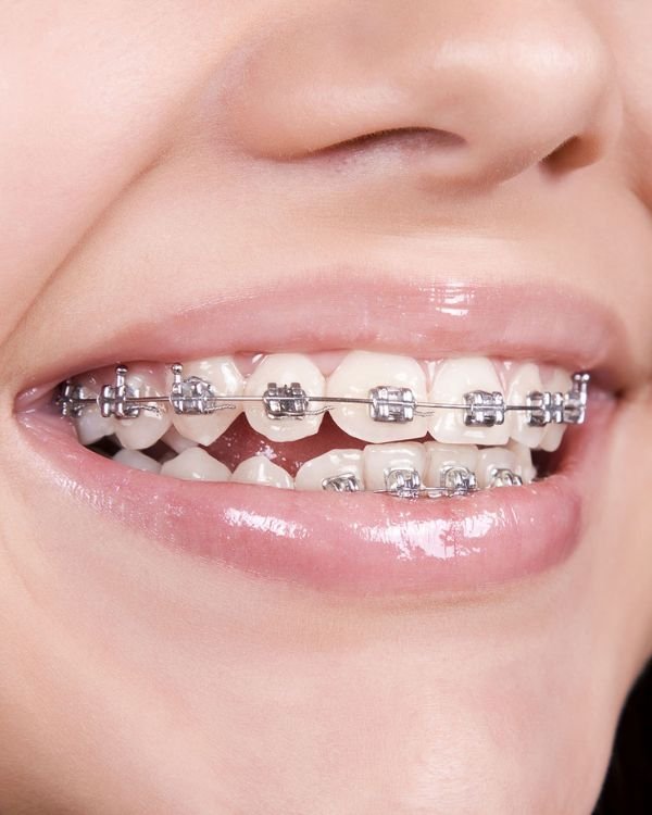 Close-up of metal braces on teeth fitted by Dr Nikhil Sharma, orthodontist in Dubai, showing precise bracket alignment and clean archwire placement.