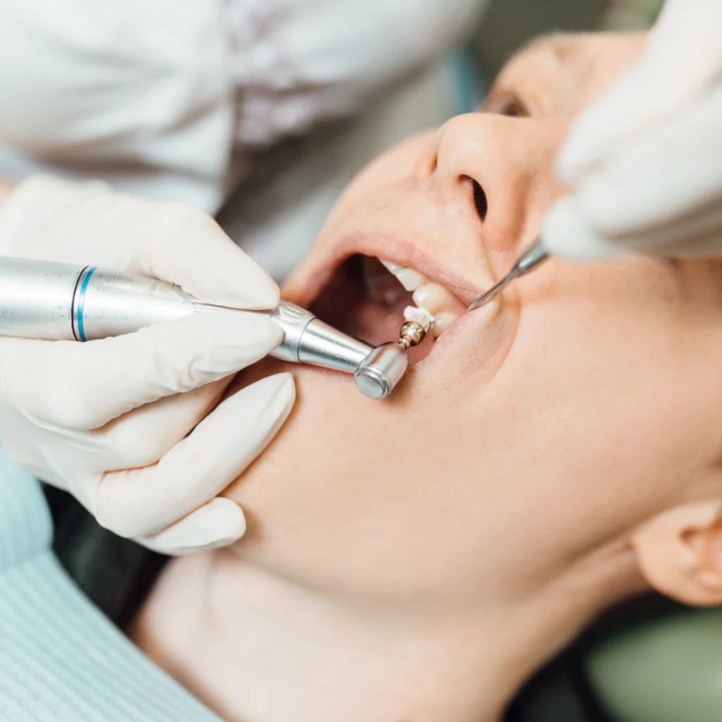 Close-up of a dentist performing professional scaling and polishing on a patient at Invisible Braces Dental & Skin Clinic.