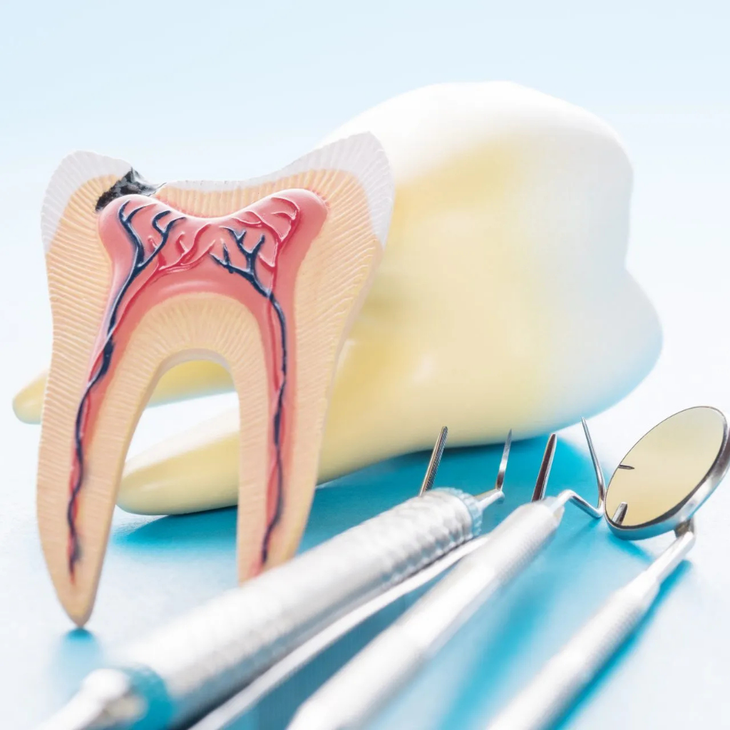Root canal treatment removes infected pulp and saves the natural tooth.