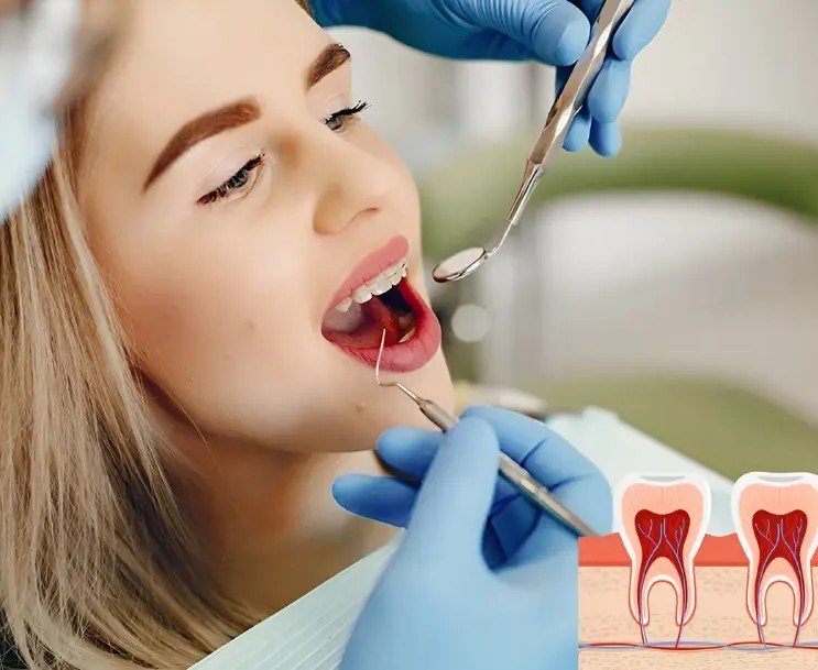 Root canal treatment being performed to remove infected tooth pulp