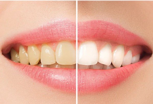 Before and after comparison showing yellow stained teeth transformed into cleaner, whiter teeth after professional teeth cleaning at Invisible Braces Dental & Skin Clinic.