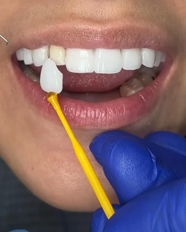 Minimal-Prep Dental Veneers for Enamel Preservation