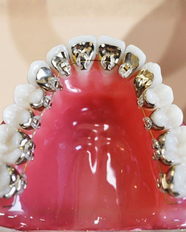 Close-up model demonstrating lingual braces placed on the inner surfaces of the teeth at Invisible Braces Dental & Skin Clinic Dubai, showcasing the fully hidden orthodontic system used by Dr. Nikhil Sharma.