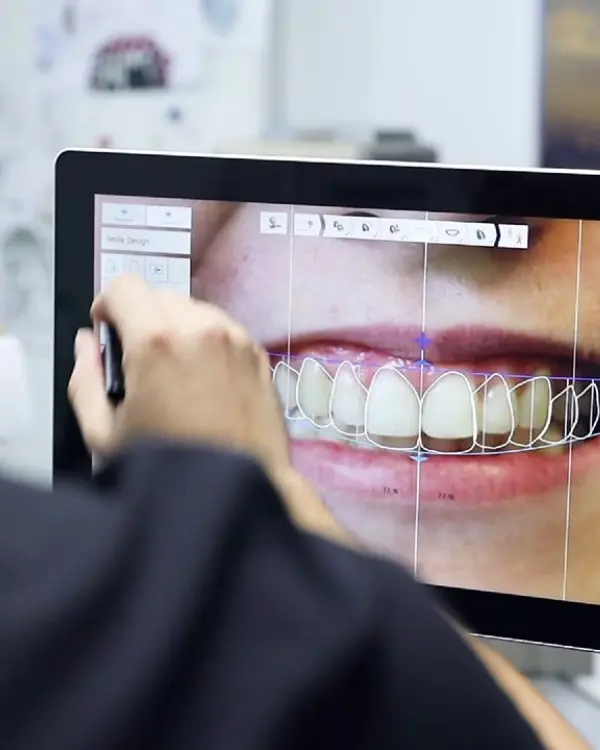 Digital Smile Design (DSD) Technology – 3D Smile Preview