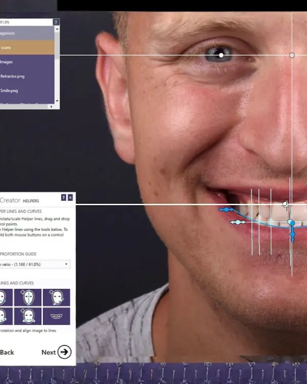 Facial aesthetic analysis using Digital Smile Design software to align teeth with facial features for a natural smile