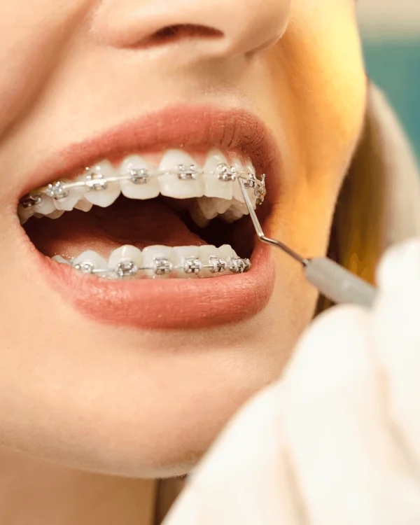 Orthodontist adjusting Damon self-ligating braces on a patient's teeth during orthodontic treatment.
