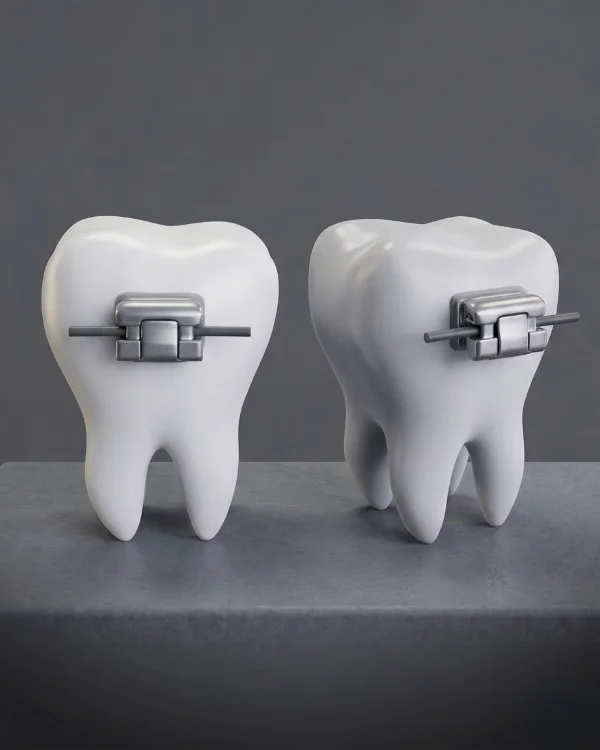 Dental model showing Damon self-ligating braces brackets and archwire used in orthodontic treatment.