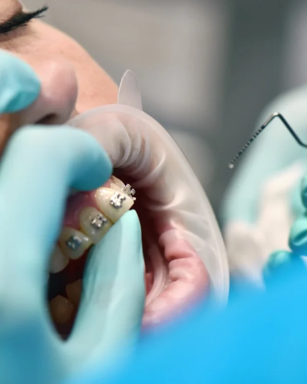 Orthodontist adjusting Damon braces on a patient’s teeth during a dental appointment.