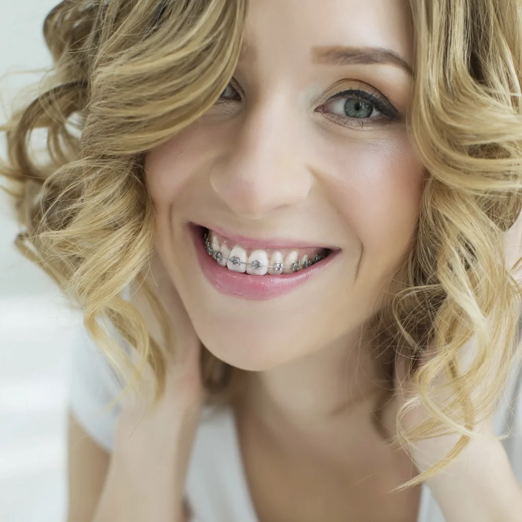 Young woman smiling with Damon self-ligating braces during orthodontic treatment.